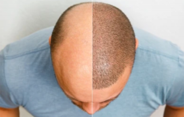 Scalp Micro-pigmentation