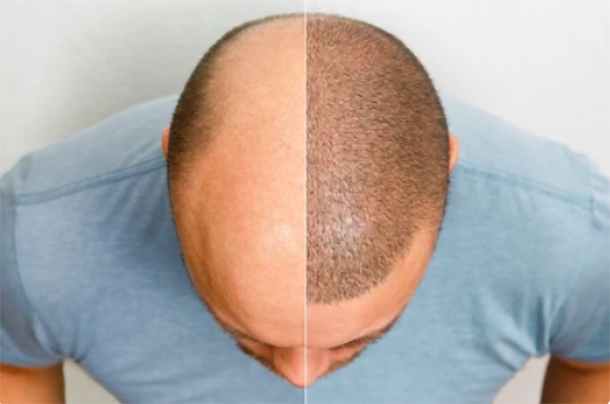 Scalp Micro-pigmentation