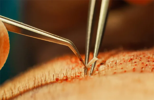 Hair Transplantation