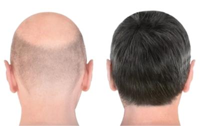 Top 10 Do’s and Don’ts For Hair Loss